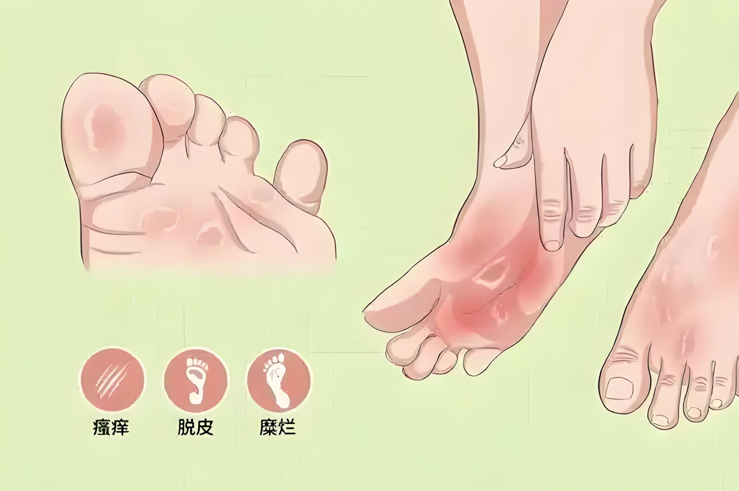 精准治疗后,她的脚保住了…… 精准治疗后,她的脚保住了……