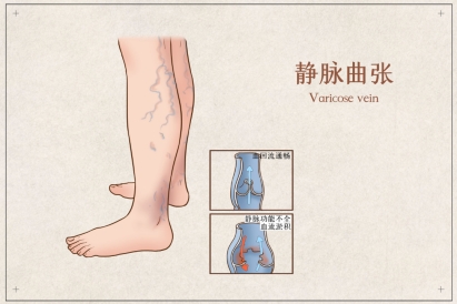 “蚯蚓腿”又丑又痛?微创技术帮您轻松摆脱它 “蚯蚓腿”又丑又痛?微创技术帮您轻松摆脱它